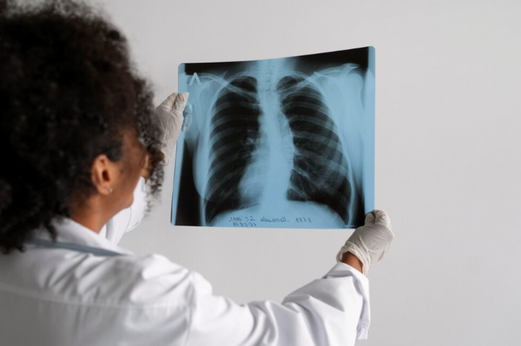 • El cáncer de pulmón es la primera causa de muerte por cáncer en el mundo